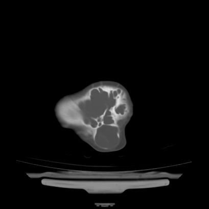 Cloverleaf skull (Radiopaedia 91901-109710 Axial bone window 136).jpg