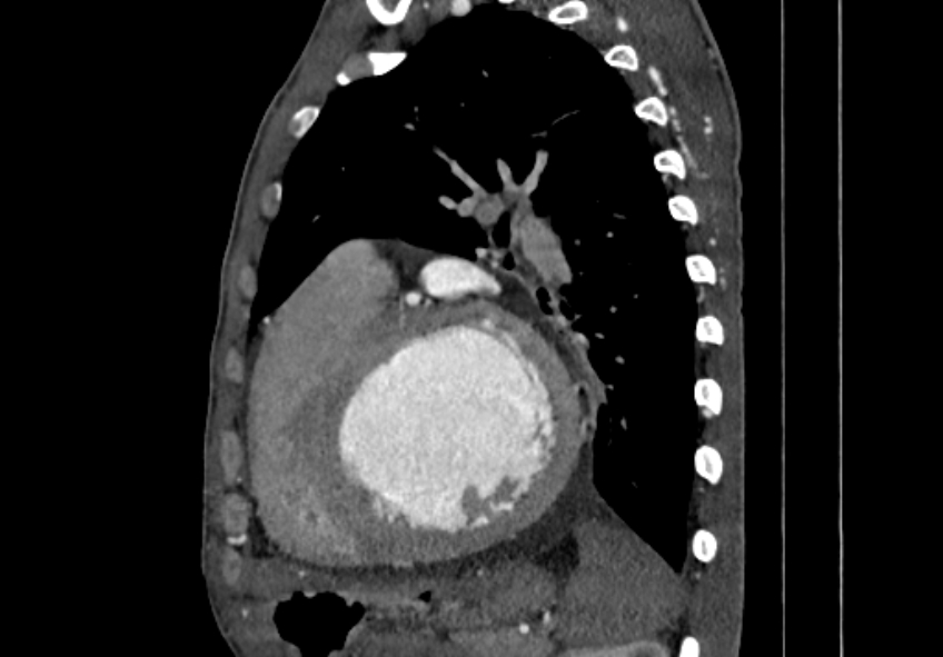 Coarctation of aorta with aortic valve stenosis (Radiopaedia 70463-80574 B 129).jpg