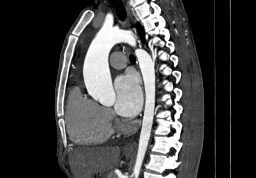 Coarctation of aorta with aortic valve stenosis (Radiopaedia 70463-80574 B 69).jpg
