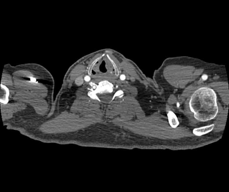 Coarctation of the aorta (Radiopaedia 53752-59822 A 2).jpg