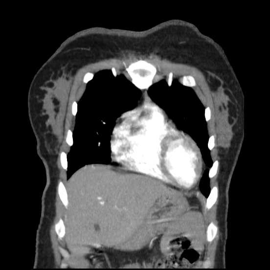 File:Coarctation of the aorta (Radiopaedia 67609-77010 B 52).jpg