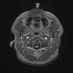 File:Cochlear incomplete partition type III associated with hypothalamic hamartoma (Radiopaedia 88756-105498 Axial T1 19).jpg