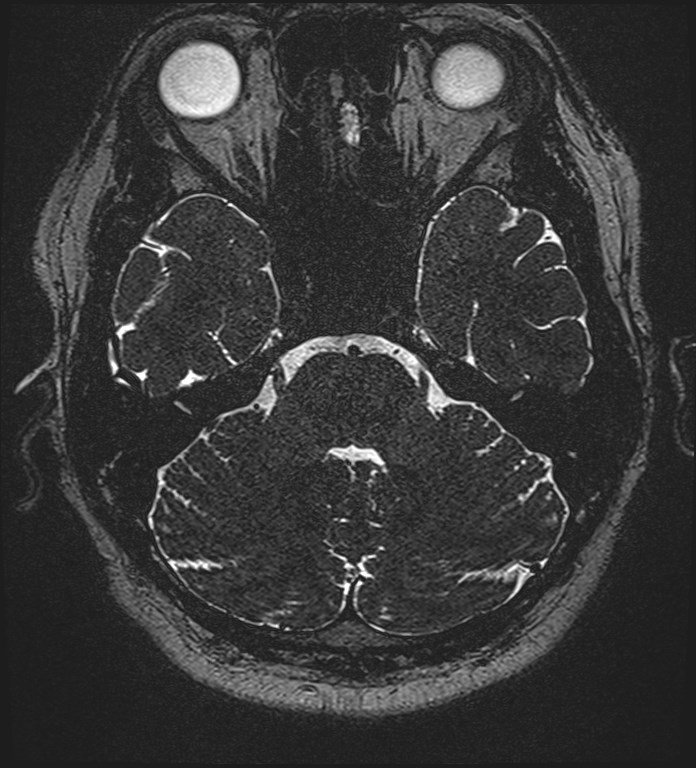 Cochlear incomplete partition type III associated with hypothalamic hamartoma (Radiopaedia 88756-105498 Axial T2 93).jpg
