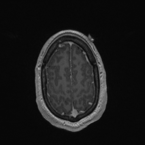 File:Colloid cyst (Radiopaedia 44510-48181 Axial T1 C+ 155).png