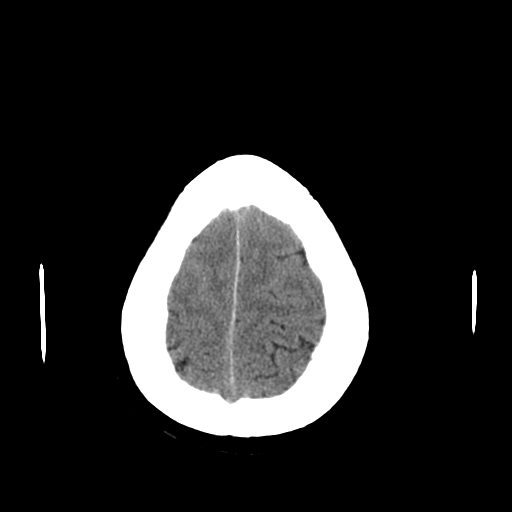 File:Colloid cyst with anterior communicating artery aneurysm (Radiopaedia 33901-35090 Axial non-contrast 24).jpg
