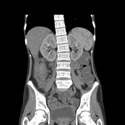 File:Colocolic fistula - Crohn disease (Radiopaedia 57063-63955 B 28).jpg