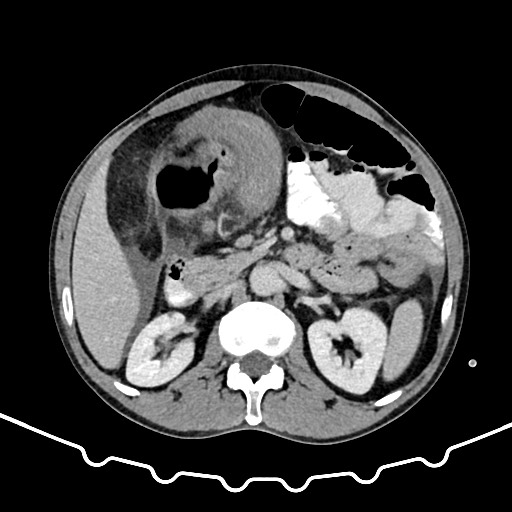 File:Colocolic intussusception due to large lipoma (Radiopaedia 68773-78482 A 66).jpg