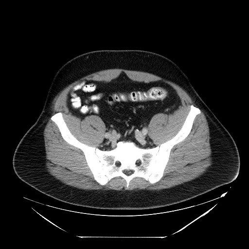 Colocolic intussusception due to lipoma (Radiopaedia 73712-84508 A 91).jpg