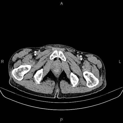 Colon adenocarcinoma - hepatic flexure (Radiopaedia 85635-101395 A 100).jpg
