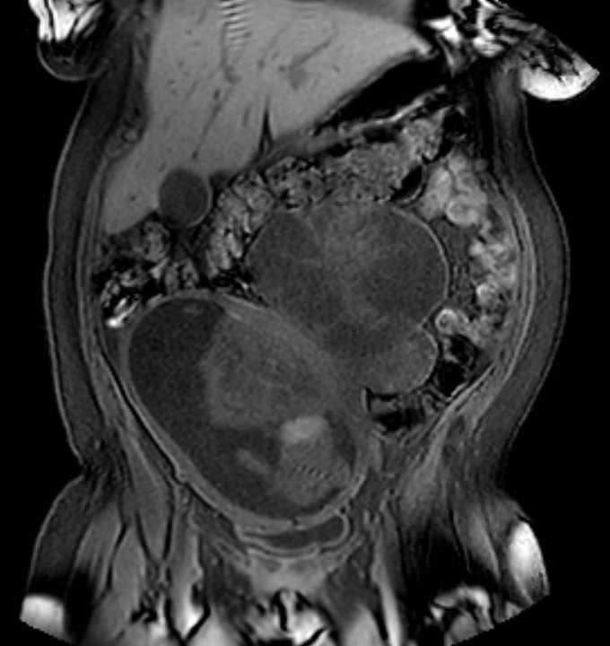 Colon adenocarcinoma with Krukenberg tumors, advanced pregnancy (Radiopaedia 67279-76645 E 26).jpg