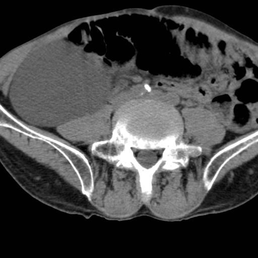 File:Colon cancer with calcified liver metastasis (Radiopaedia 74423-85309 Axial non-contrast 70).jpg