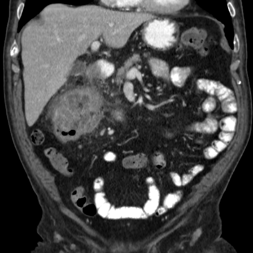 File:Colon cancer with duodenal invasion (Radiopaedia 16278-15958 B 22).jpg