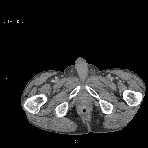 File:Colonic cancer (ultrasound and TC imaging) (Radiopaedia 50346-55713 A 161).jpg