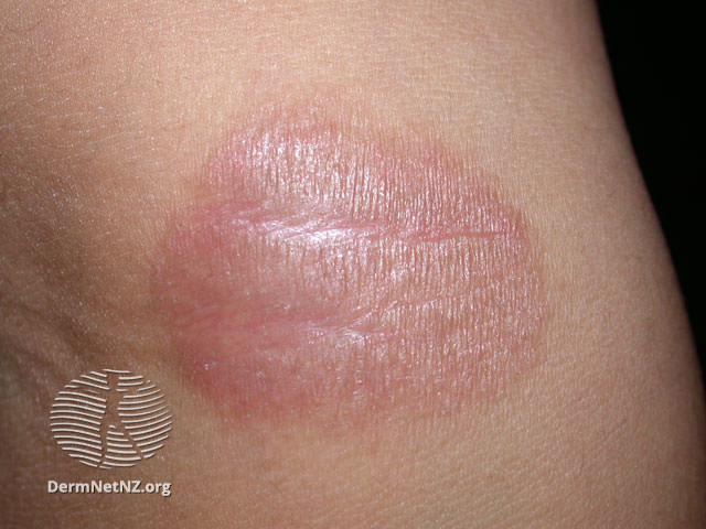 File:Contact dermatitis to ethylenediamine (DermNet NZ dermatitis-ethdiam1).jpg