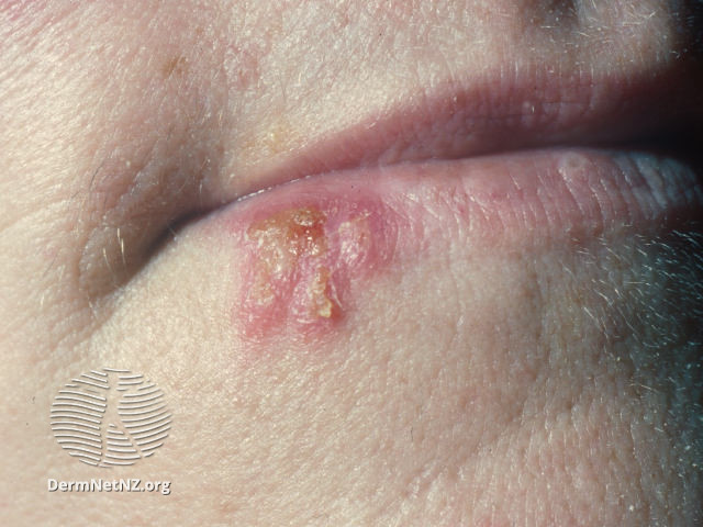 File:Herpes simplex labialis (DermNet NZ herpes-simplex-labialis-03).jpg