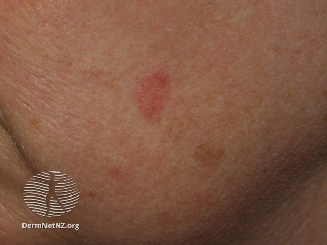Intraepidermal carcinoma (DermNet NZ lesions-scc-in-situ-2952).jpg