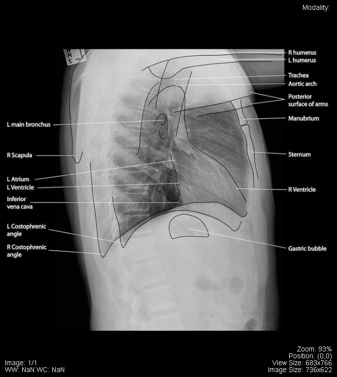 Lateral Chest x-ray labelled.png