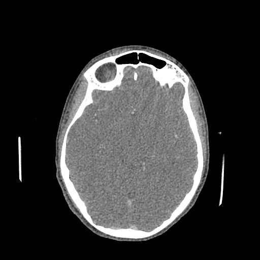 File:Nasal pyogenic granuloma (lobular capillary hemangioma) (Radiopaedia 85536-101244 C 106).jpg