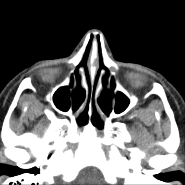 Nasolabial cyst (Radiopaedia 33987-35205 Axial non-contrast 25).jpg