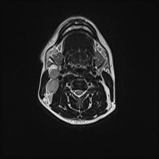 File:Nasopharyngeal carcinoma with perineural spread (Radiopaedia 55030-61380 Axial T2 50).jpg