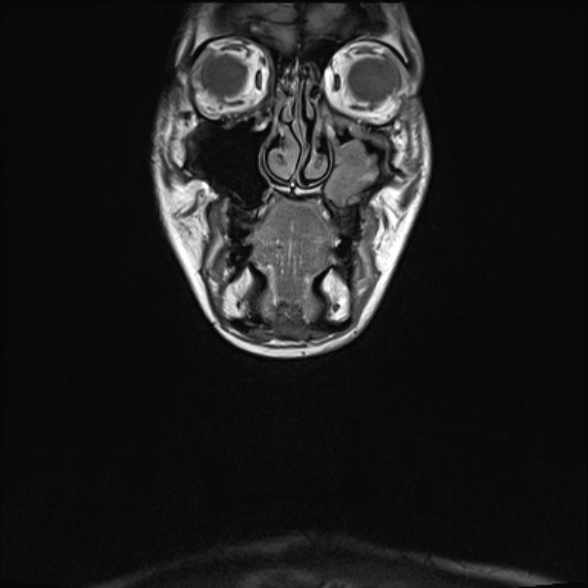Nasopharyngeal carcinoma with skull base invasion (Radiopaedia 53415-59485 Coronal T1 36).jpg