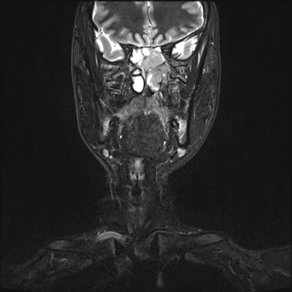 Nasopharyngeal carcinoma with skull base invasion (Radiopaedia 53415-59485 Coronal T2 fat sat 26).jpg