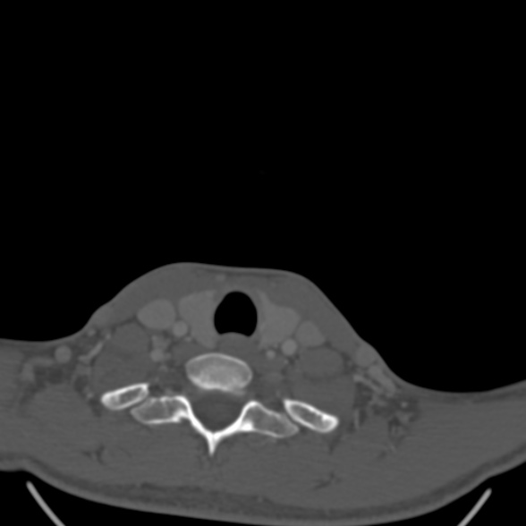 Nasopharyngeal carcinoma with skull base invasion (Radiopaedia 53415-59705 Axial bone window 175).jpg