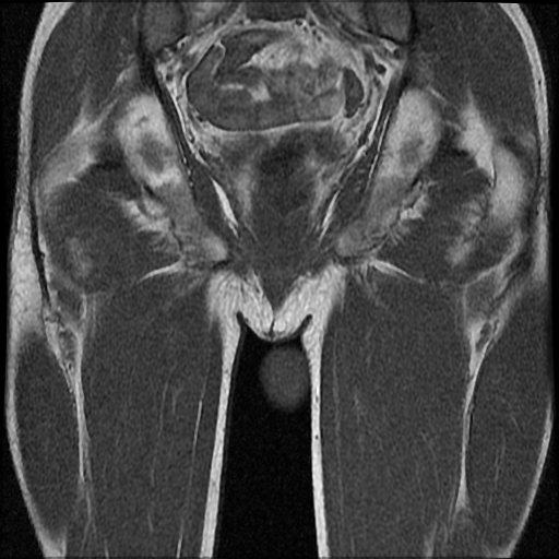 File:Necrotizing epididymo-orchitis with intra-testicular abscess (Radiopaedia 29397-29860 Coronal T1 18).jpg
