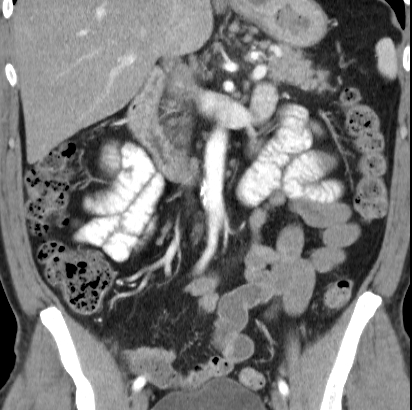 File:Necrotizing pancreatitis with acute necrotic collection (Radiopaedia 14470-14417 C 20).jpg