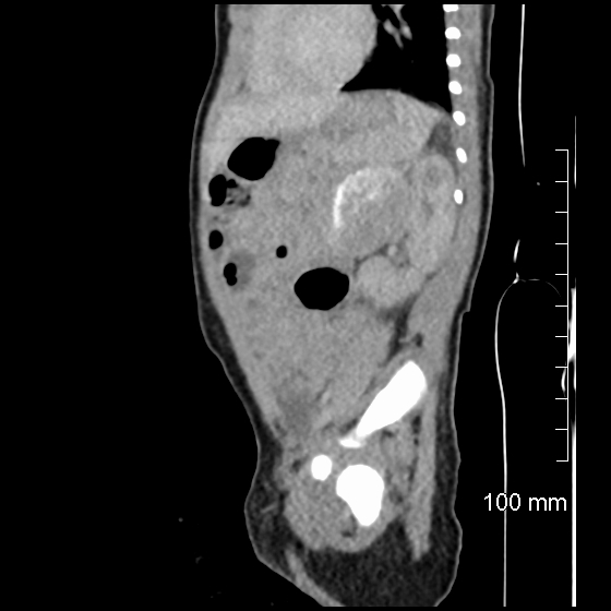 File:Neonatal neuroblastoma (Radiopaedia 56651-63438 C 34).jpg