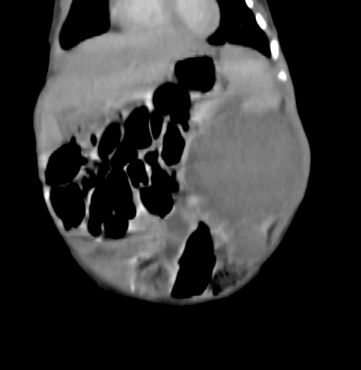 Nephroblastomatosis (Radiopaedia 71294-81607 B 104).jpg