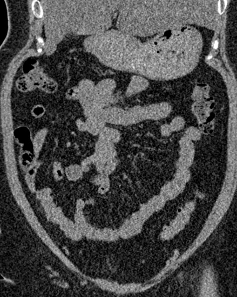 File:Nephrostomy for urosepsis (Radiopaedia 26180-26330 non-contrast 29).jpg