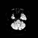 File:Neuro-Behcet's disease (Radiopaedia 21557-21506 Axial DWI 7).jpg