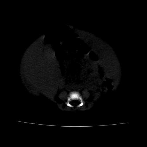 File:Neuroblastoma (Radiopaedia 20876-20799 Axial bone window 17).jpg