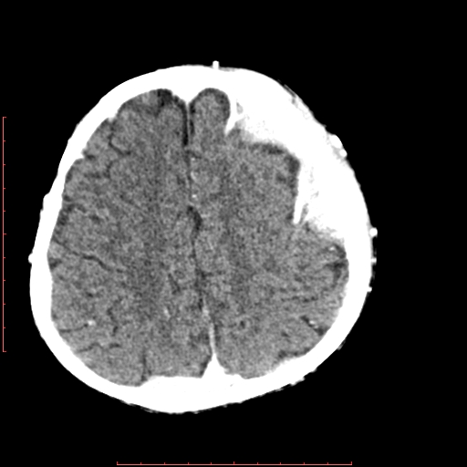 File:Neuroblastoma skull metastasis (Radiopaedia 56053-62683 Axial +Contrast 13).jpg
