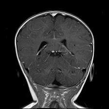 File:Neurofibromatosis type 1 (Radiopaedia 30089-30671 Coronal T1 C+ 20).jpg