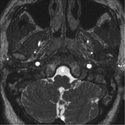 Neurofibromatosis type 2 (Radiopaedia 44936-48838 E 9).png