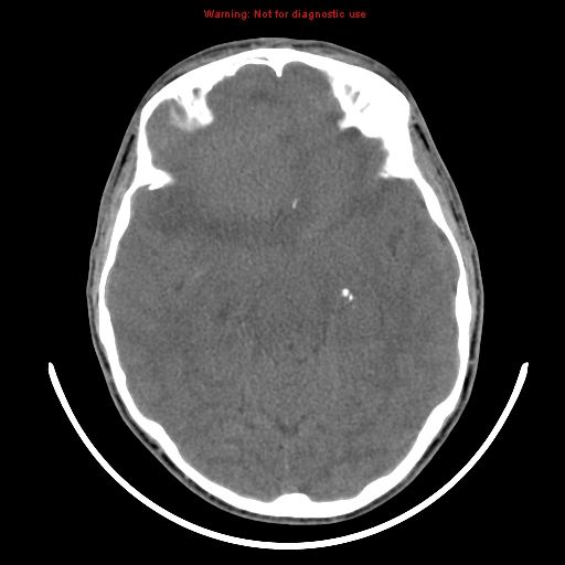 File:Neurofibromatosis type 2 (Radiopaedia 8953-9732 Axial non-contrast 16).jpg