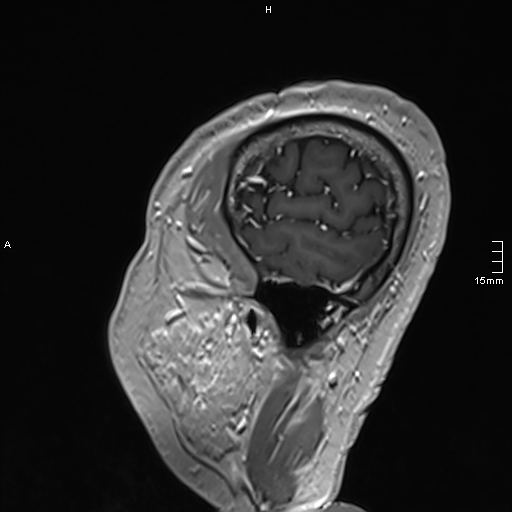 Neurosarcoidosis - involvement of the mesial temporal lobes (Radiopaedia 67429-76820 Sagittal T1 C+ 150).jpg