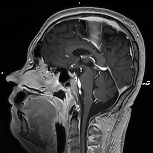 Neurosarcoidosis - involvement of the mesial temporal lobes (Radiopaedia 67429-76820 Sagittal T1 C+ 88).jpg