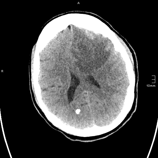 File:Neurotoxoplasmosis - concentric target sign (Radiopaedia 70644-80783 Axial non-contrast 23).jpg