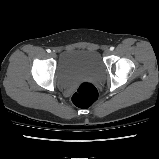 File:Normal CT angiogram of pelvis (Radiopaedia 45390-49430 A 45).jpg