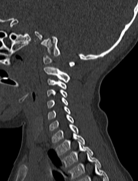 Normal CT cervical spine - pediatric (Radiopaedia 52549-58462 Sagittal bone window 61).jpg