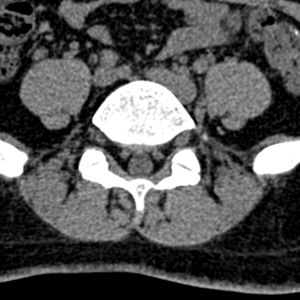 Normal CT lumbar spine (Radiopaedia 53981-60118 Axial non-contrast 82).jpg