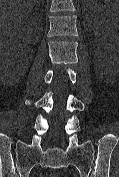 Normal CT lumbar spine (Radiopaedia 53981-60118 Coronal bone window 35).jpg