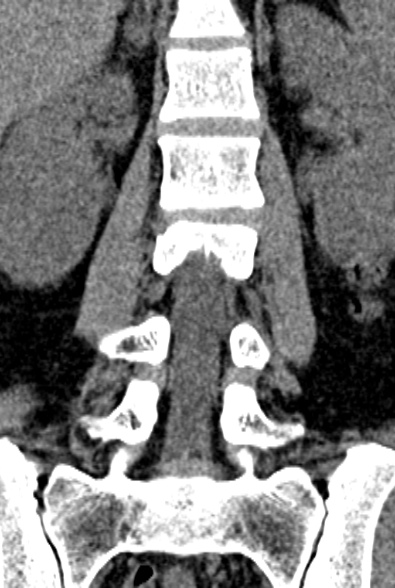 Normal CT lumbar spine (Radiopaedia 53981-60118 F 44).jpg