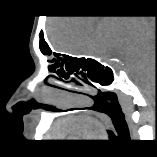 Normal CT paranasal sinuses (Radiopaedia 42286-45390 F 85).jpg
