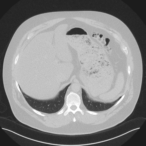Normal HRCT (Radiopaedia 40797-43458 Axial lung window 53).png