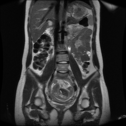 File:Normal MRI abdomen in pregnancy (Radiopaedia 88001-104541 Coronal T2 18).jpg