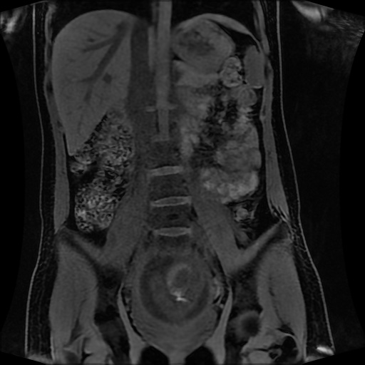 Normal MRI abdomen in pregnancy (Radiopaedia 88001-104541 M 79).jpg
